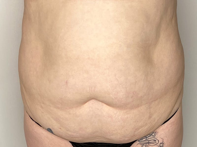 Tummy Tuck Before & After Gallery - Patient 143746357 - Image 1