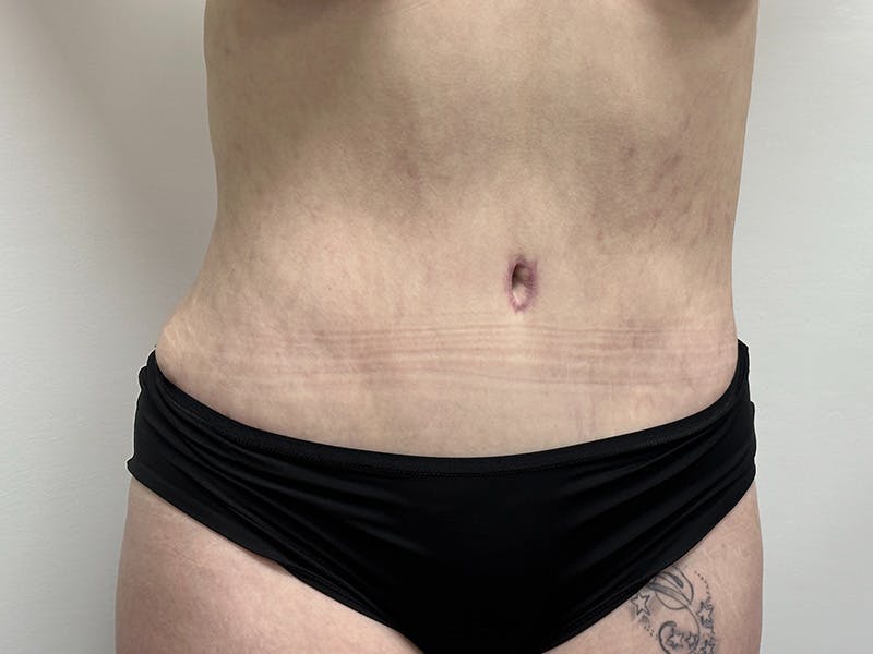 Tummy Tuck Before & After Gallery - Patient 143746357 - Image 2