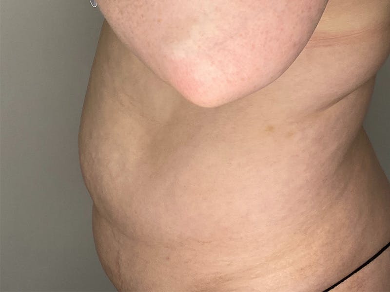Tummy Tuck Before & After Gallery - Patient 143746357 - Image 3