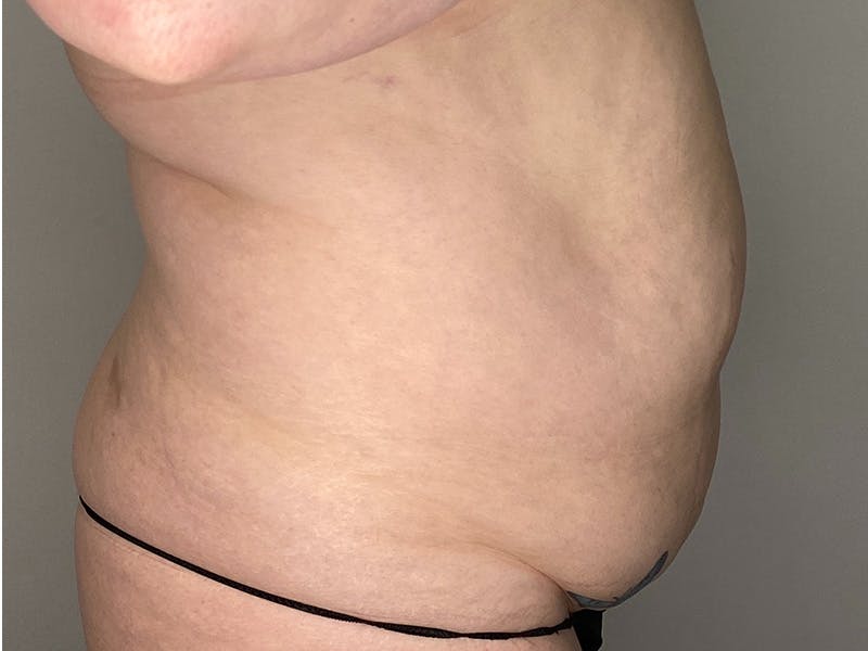 Tummy Tuck Before & After Gallery - Patient 143746357 - Image 5