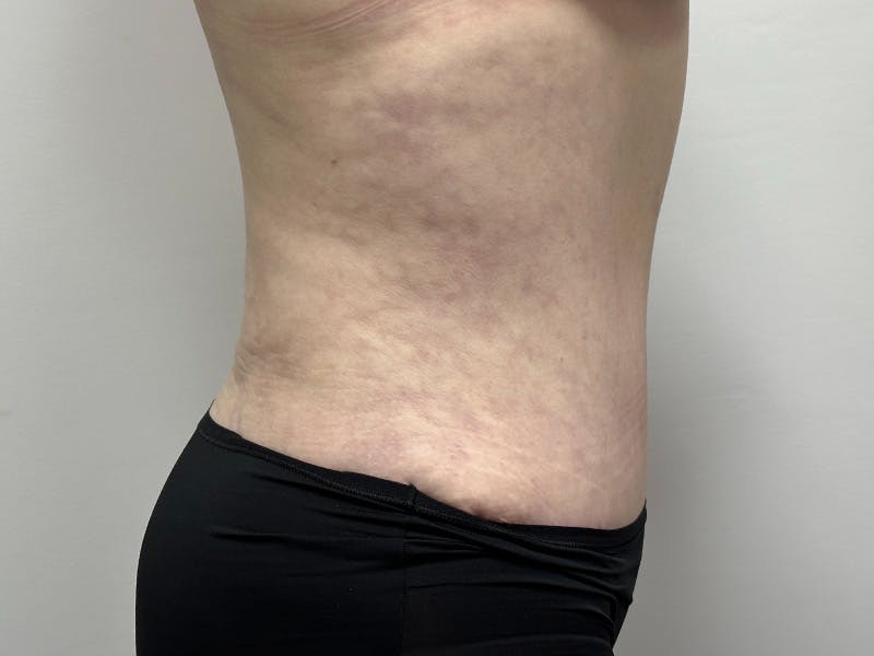 Tummy Tuck Before & After Gallery - Patient 143746357 - Image 6