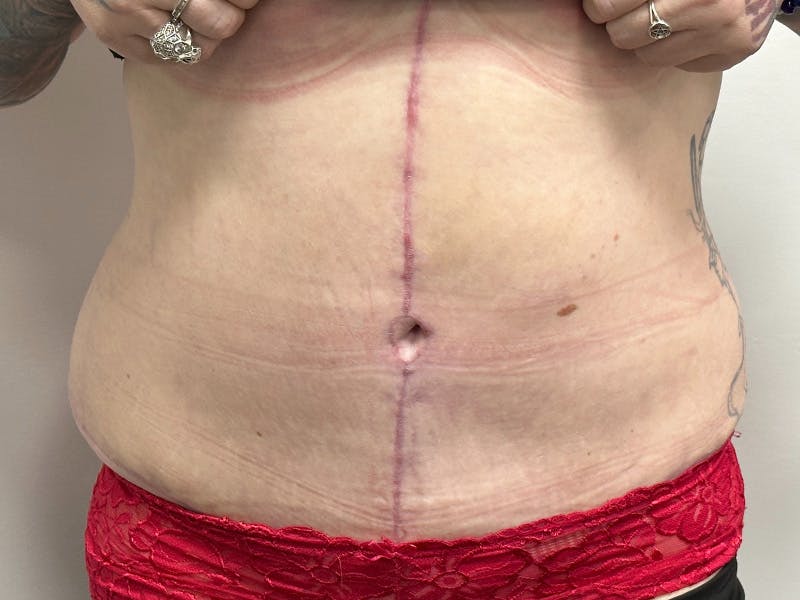 Tummy Tuck Before & After Gallery - Patient 143746356 - Image 2