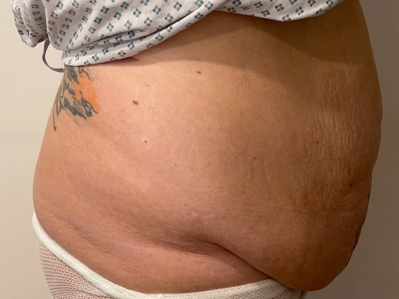 Tummy Tuck Before & After Gallery - Patient 143746356 - Image 3