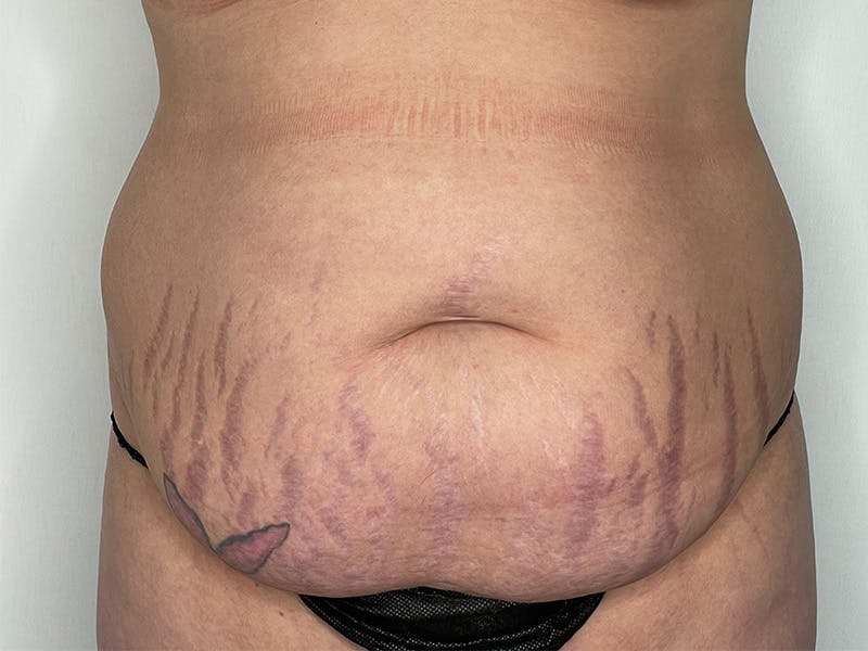 Tummy Tuck Before & After Gallery - Patient 143746355 - Image 1
