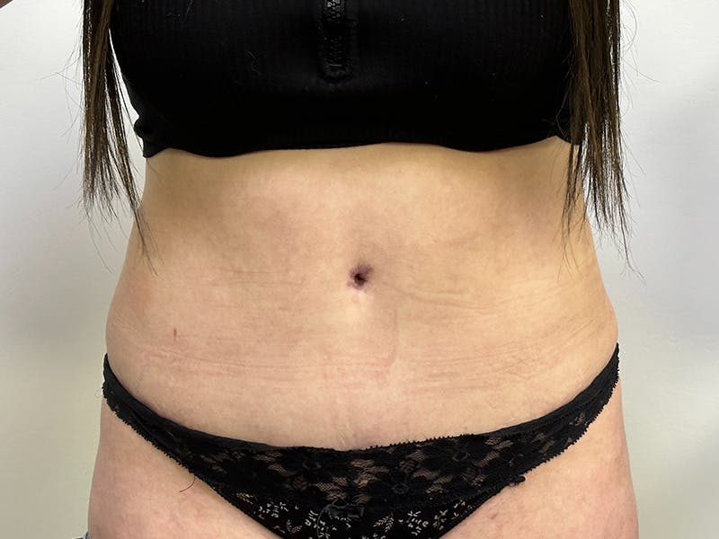 Tummy Tuck Before & After Gallery - Patient 143746355 - Image 2