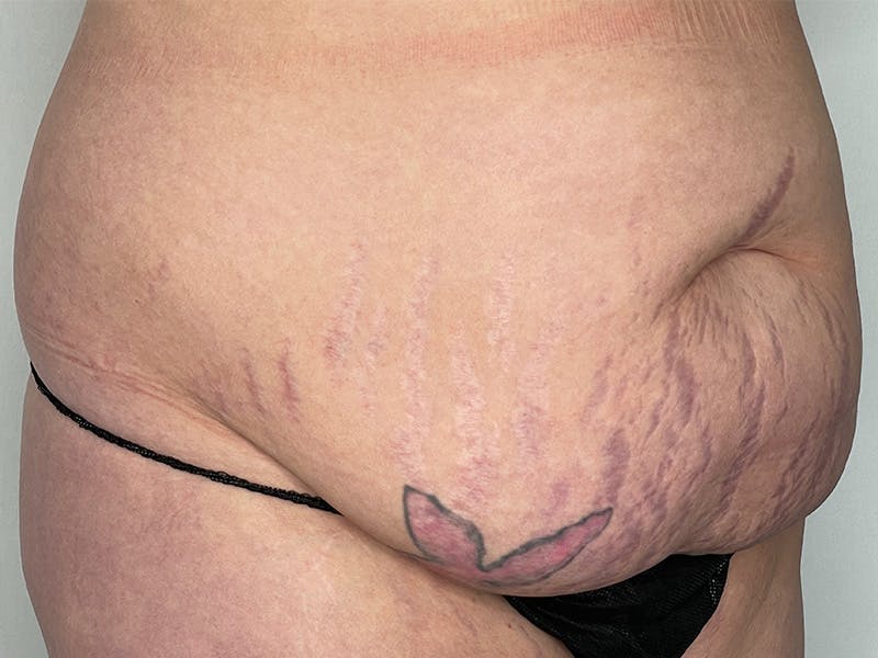 Tummy Tuck Before & After Gallery - Patient 143746355 - Image 3
