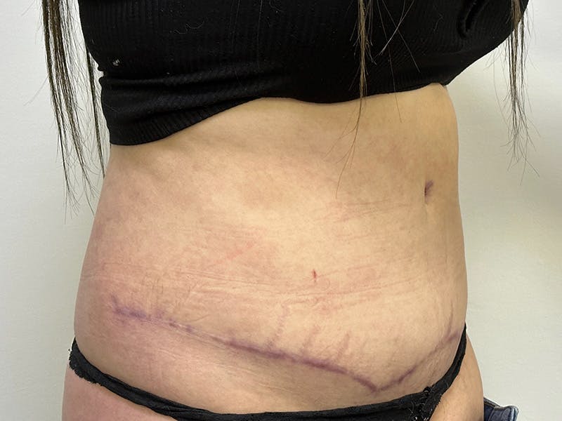 Tummy Tuck Before & After Gallery - Patient 143746355 - Image 4
