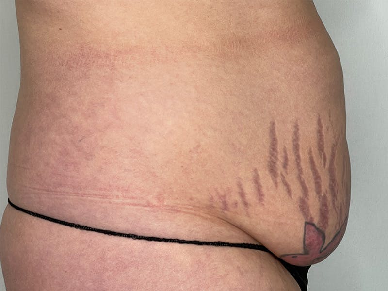 Tummy Tuck Before & After Gallery - Patient 143746355 - Image 5