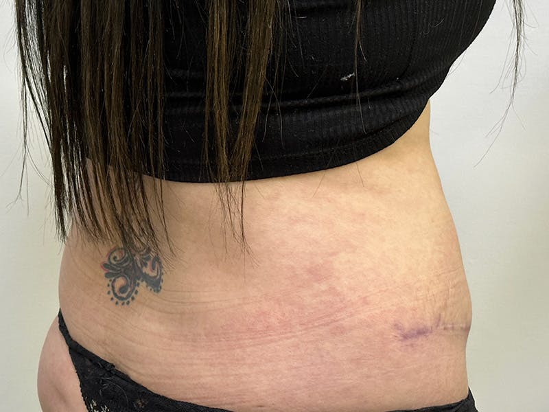 Tummy Tuck Before & After Gallery - Patient 143746355 - Image 6