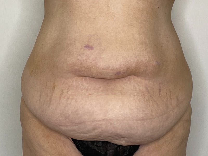 Tummy Tuck Before & After Gallery - Patient 143746360 - Image 1