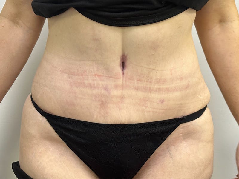 Tummy Tuck Before & After Gallery - Patient 143746360 - Image 2