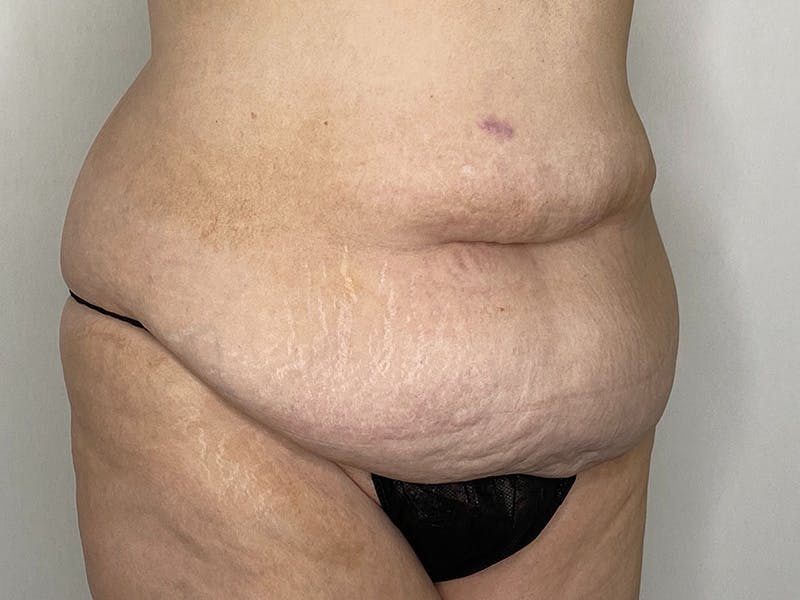 Tummy Tuck Before & After Gallery - Patient 143746360 - Image 3