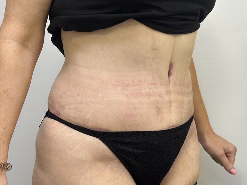 Tummy Tuck Before & After Gallery - Patient 143746360 - Image 4
