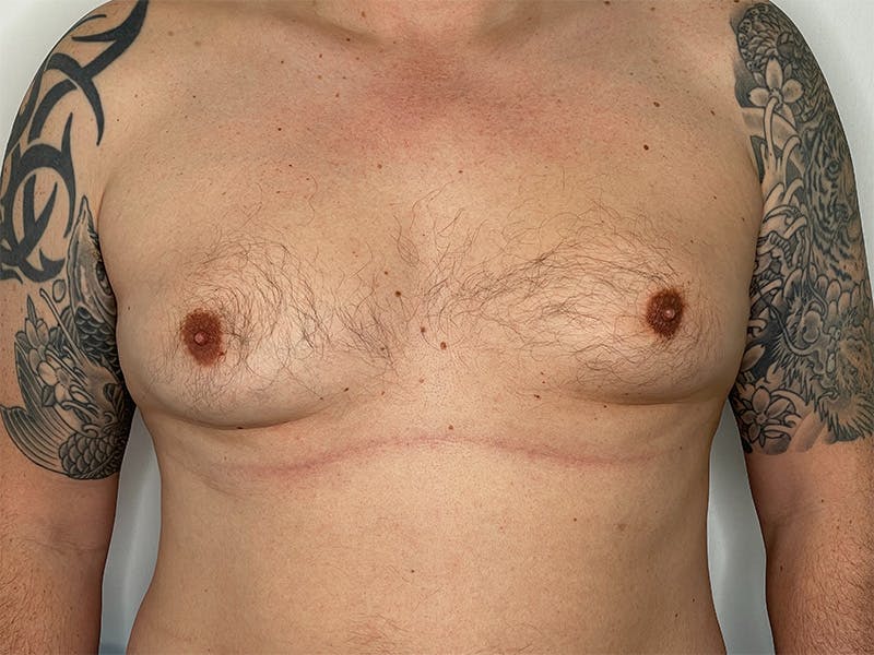 Gynecomastia (Male Breast Reduction) Before & After Gallery - Patient 143746376 - Image 1