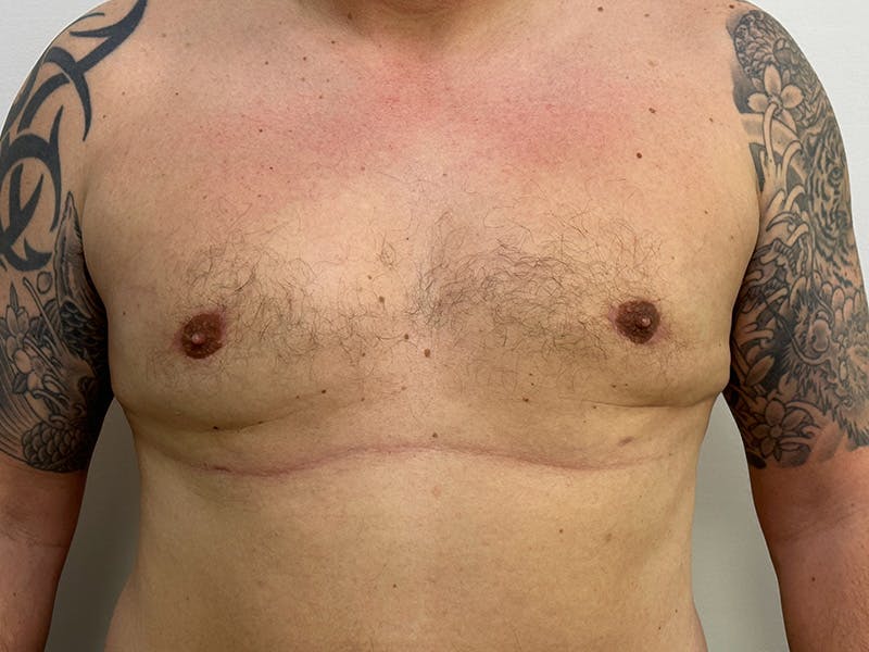 Gynecomastia (Male Breast Reduction) Before & After Gallery - Patient 143746376 - Image 2