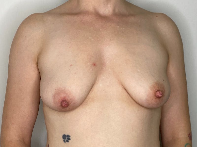 Breast Uplift with Implants Before & After Gallery - Patient 143746382 - Image 1