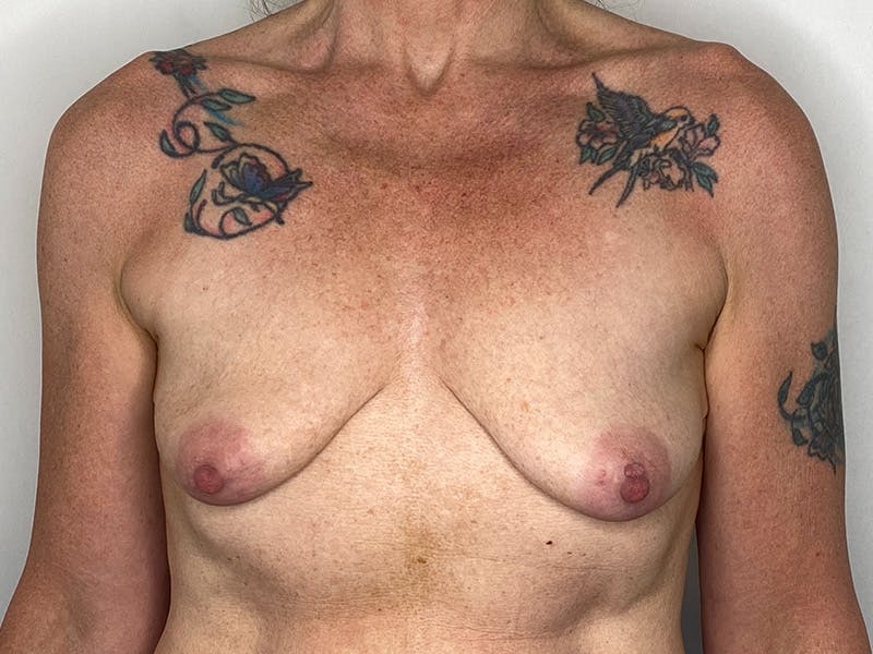 Breast Uplift with Implants Before & After Gallery - Patient 143746381 - Image 1