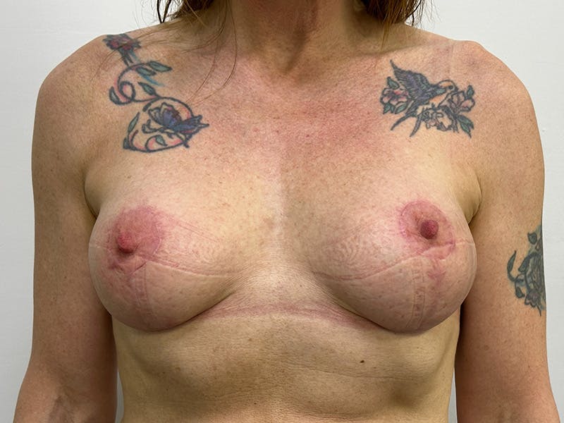 Breast Uplift with Implants Before & After Gallery - Patient 143746381 - Image 2