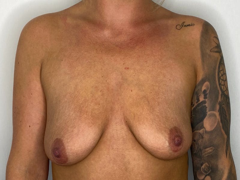 Breast Uplift with Implants Before & After Gallery - Patient 143746388 - Image 1