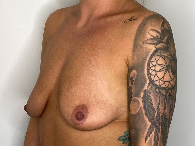 Breast Uplift with Implants Before & After Gallery - Patient 143746388 - Image 3