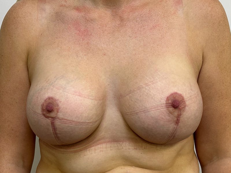 Breast Uplift with Implants Before & After Gallery - Patient 143746387 - Image 2