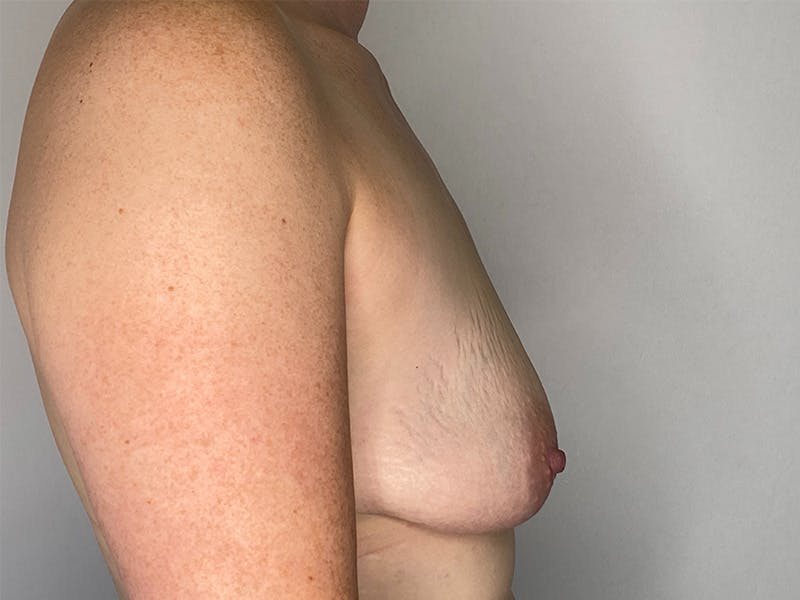Breast Uplift with Implants Before & After Gallery - Patient 143746387 - Image 5