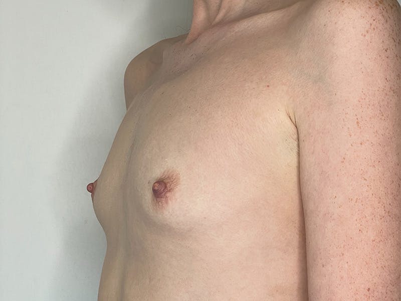Breast Augmentation Before & After Gallery - Patient 143746518 - Image 1