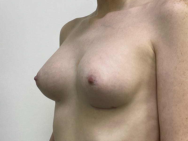 Breast Augmentation Before & After Gallery - Patient 143746518 - Image 2