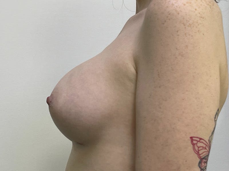 Breast Augmentation Before & After Gallery - Patient 143746518 - Image 4