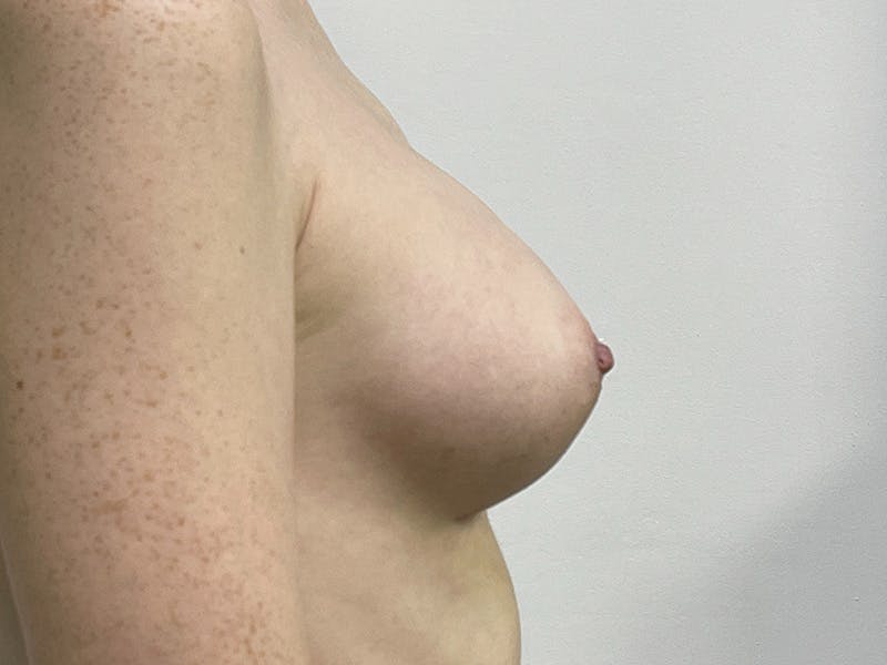 Breast Augmentation Before & After Gallery - Patient 143746518 - Image 6