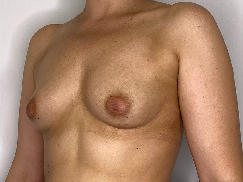 Breast Augmentation Before & After Gallery - Patient 143746520 - Image 5