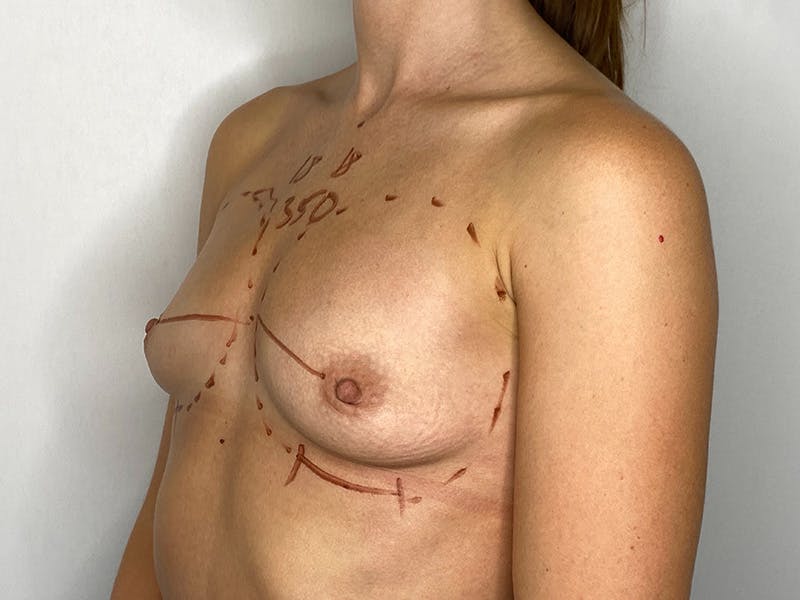 Breast Augmentation Before & After Gallery - Patient 143746525 - Image 1