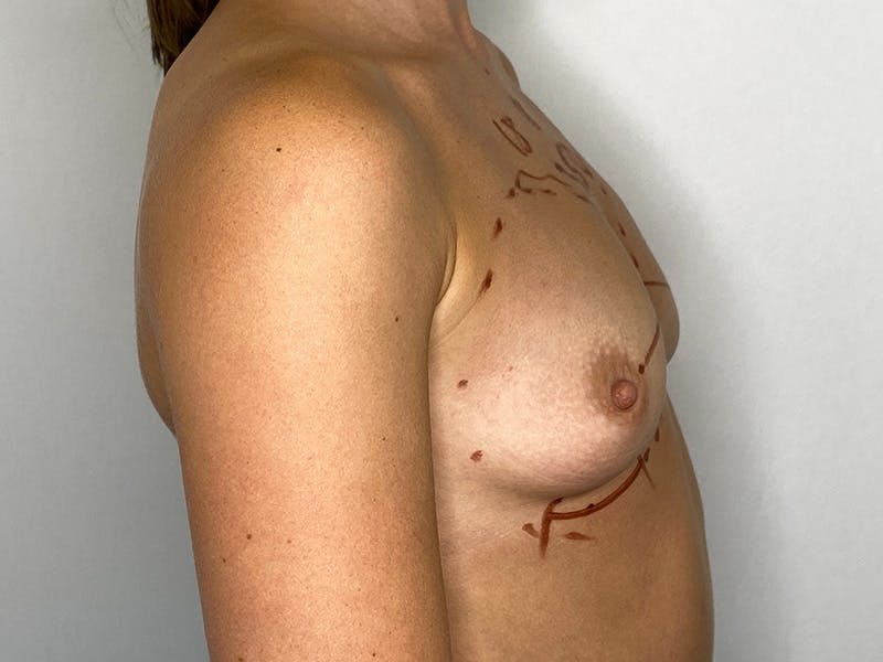Breast Augmentation Before & After Gallery - Patient 143746525 - Image 3