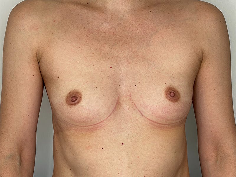 Breast Augmentation Before & After Gallery - Patient 143746524 - Image 1