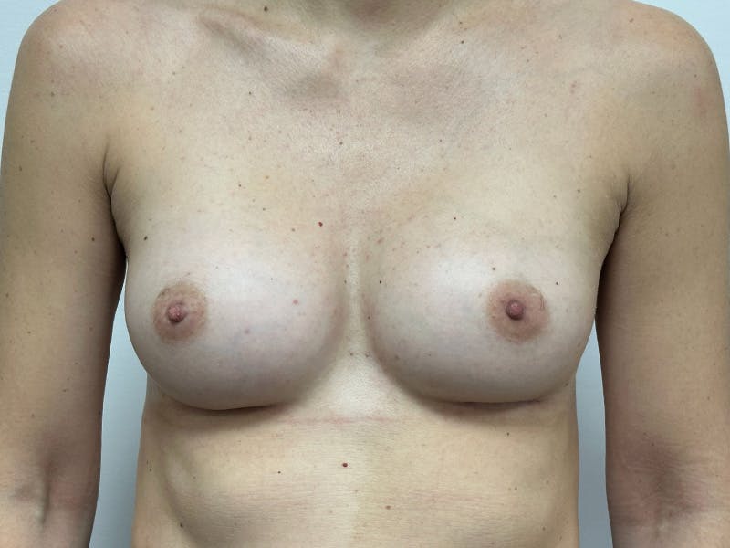 Breast Augmentation Before & After Gallery - Patient 143746524 - Image 2