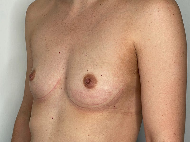 Breast Augmentation Before & After Gallery - Patient 143746524 - Image 3