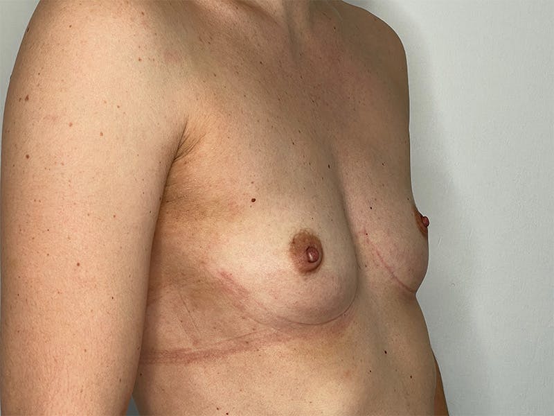 Breast Augmentation Before & After Gallery - Patient 143746524 - Image 5