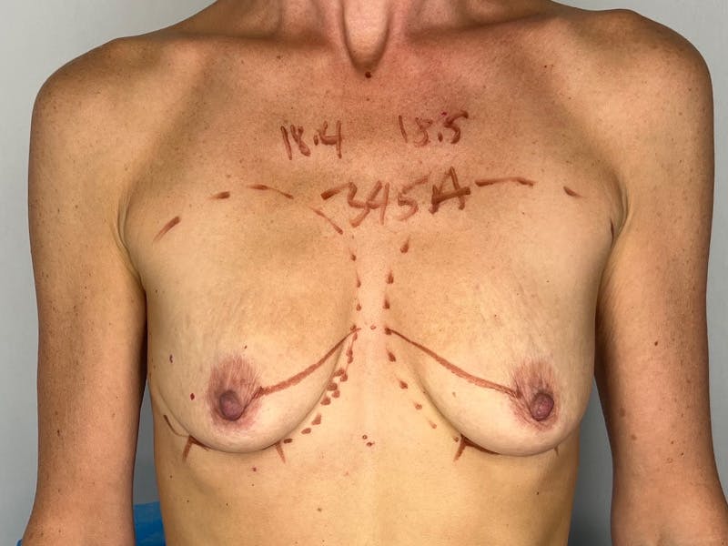 Breast Augmentation Before & After Gallery - Patient 143746523 - Image 1