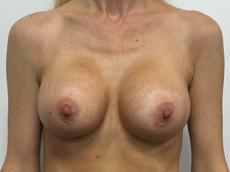 Breast Augmentation Before & After Gallery - Patient 143746523 - Image 2