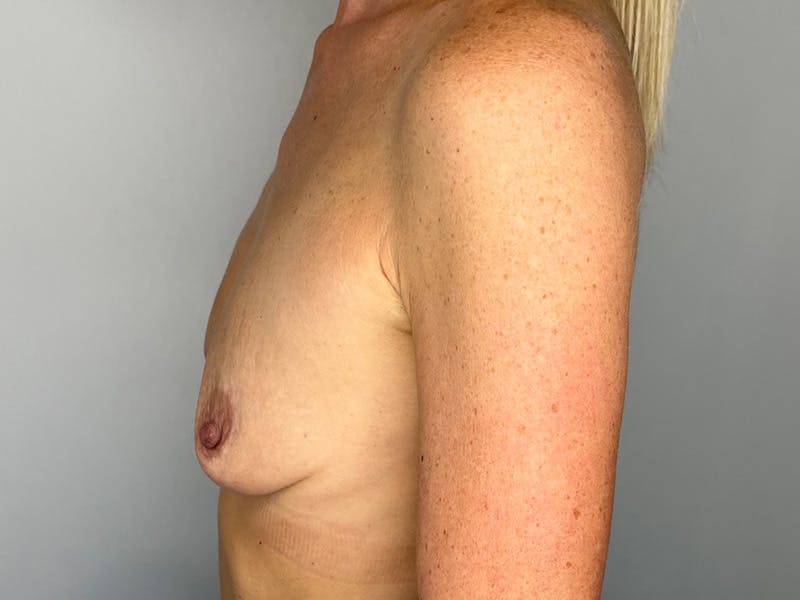 Breast Augmentation Before & After Gallery - Patient 143746523 - Image 3