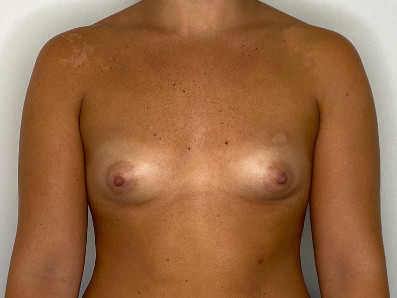 Breast Augmentation Before & After Gallery - Patient 143746543 - Image 1