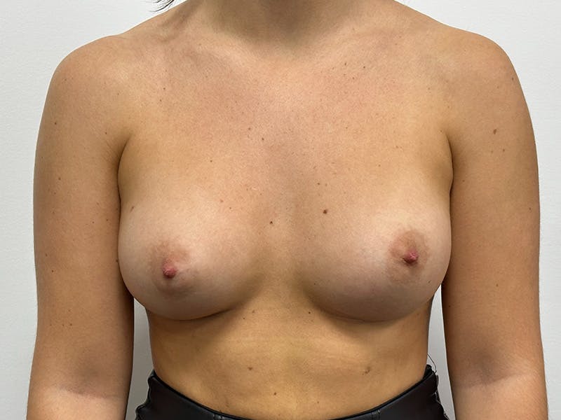 Breast Augmentation Before & After Gallery - Patient 143746543 - Image 2