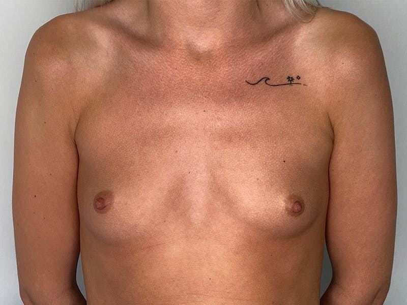 Breast Augmentation Before & After Gallery - Patient 143746544 - Image 1