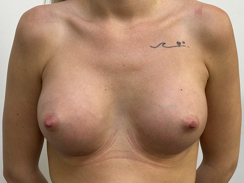Breast Augmentation Before & After Gallery - Patient 143746544 - Image 2