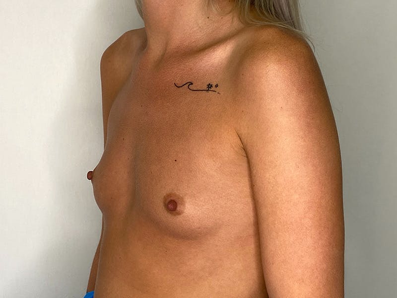 Breast Augmentation Before & After Gallery - Patient 143746544 - Image 3