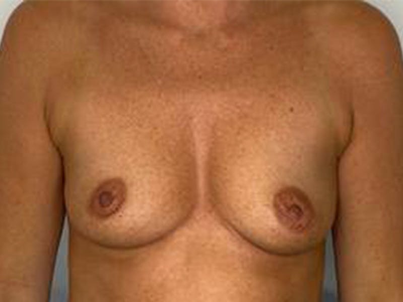 Breast Augmentation Before & After Gallery - Patient 147376292 - Image 1