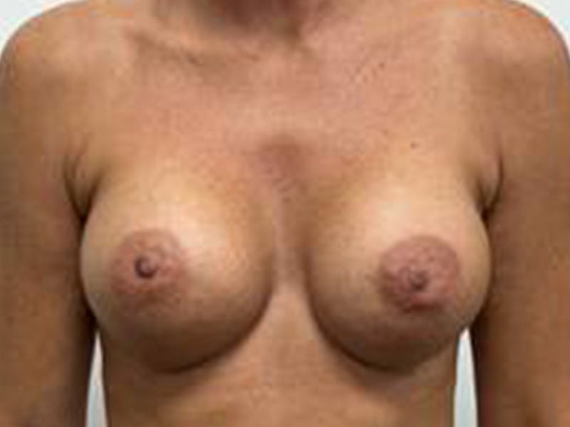 Breast Augmentation Before & After Gallery - Patient 147376292 - Image 2