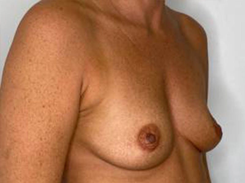 Breast Augmentation Before & After Gallery - Patient 147376292 - Image 3