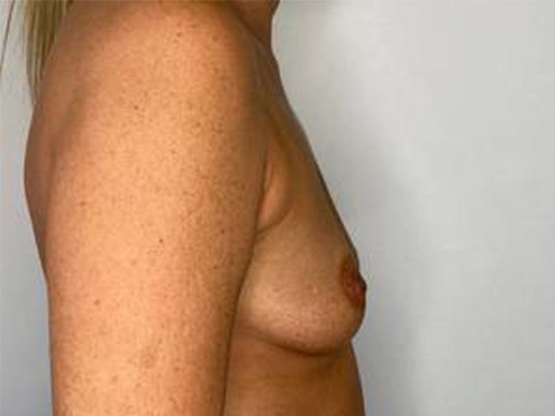 Breast Augmentation Before & After Gallery - Patient 147376292 - Image 5