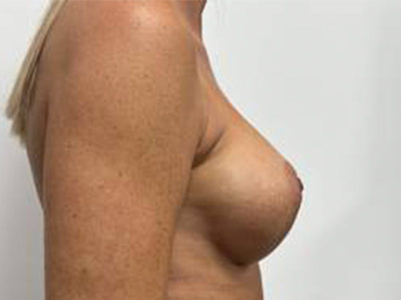 Breast Augmentation Before & After Gallery - Patient 147376292 - Image 6